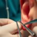earlobe repair surgery