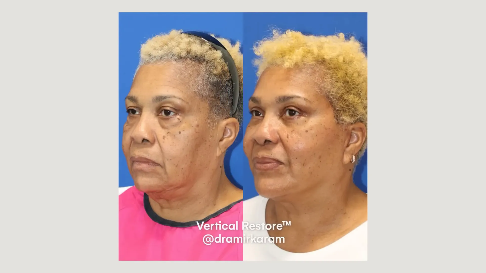 דוגמה למראה לאחר הסרת שומן בלחיים