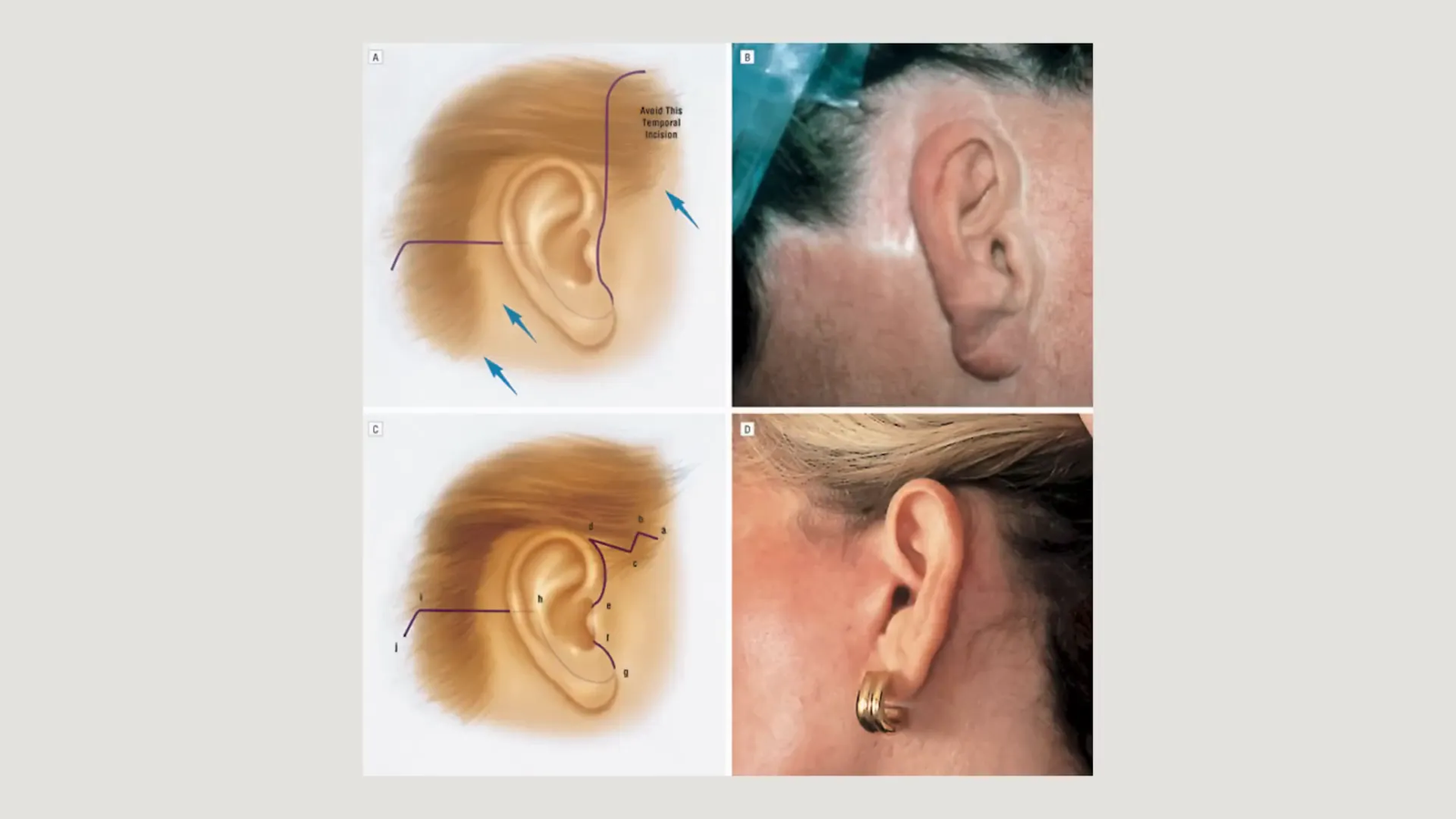 הדגמת אנטומיה של האוזן